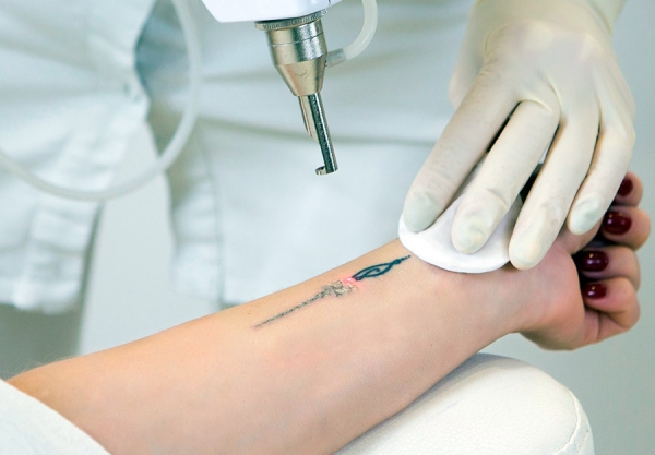 Как безопасно и эффективно свести татуировку? Отвечает специалист