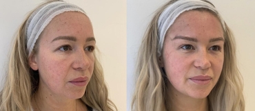 Что не так с операцией «лисьи глазки»: 10 реальных фото до и после процедуры