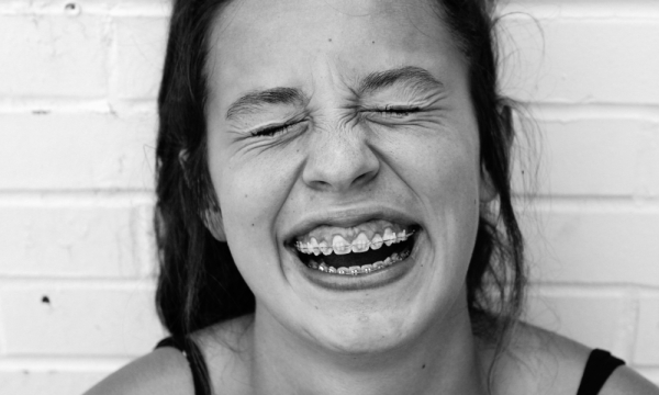 Все, что нужно знать о брекетах: 7 вопросов стоматологу